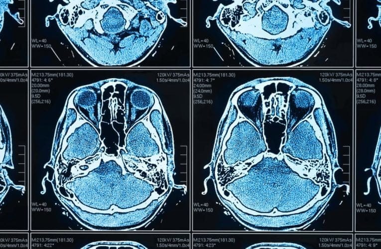 AI inom medicinteknik